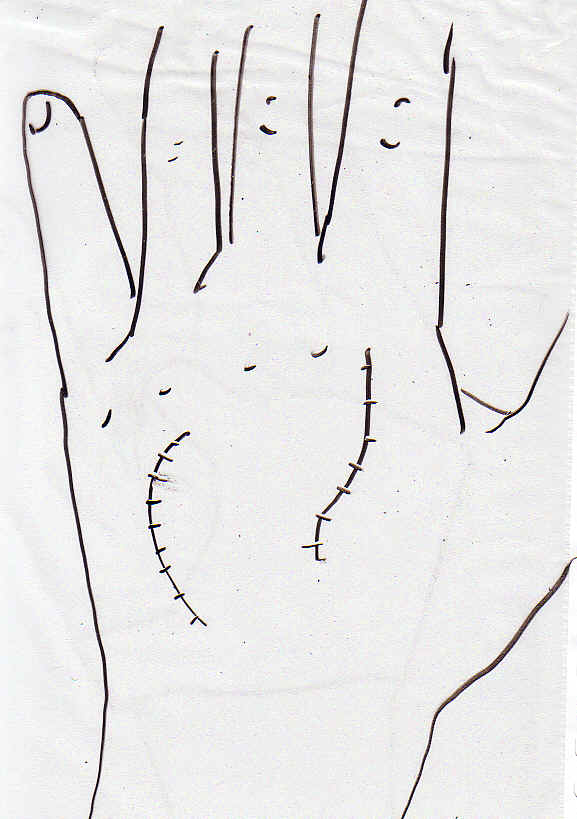Cicatrices au dos de la main.