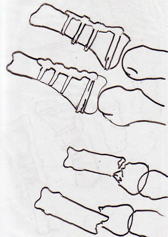 Fracture dplace. de phalanges.