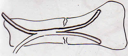 Fracture transversale.